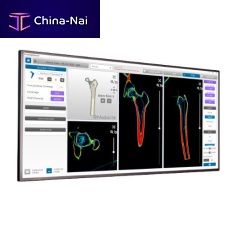 CT software MyHip®analysisplanninghip
