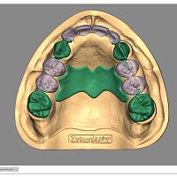 Dental restoration software Partial-Plannerimport3D simulationfor dental prosthesis design
