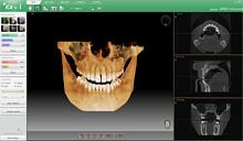 Dental software Ez3D-ifor dental imaginganalysisdiagnostic