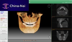 Dental software Ez3D-ifor dental imaginganalysisdiagnostic
