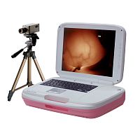 Video colposcope AD-1202transportable