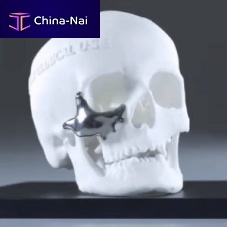 Custom-made periorbital implant