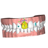 Dental laboratory software ALIGNERorthodonticfor dental officestreatment planning
