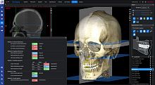 Cephalometric analysis software Romexis® orthodontic3D viewing3D simulation