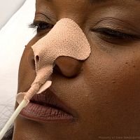 Nasogastric tube catheter fixation 160adhesive