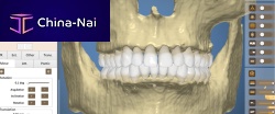 Dental software OrthoAnalysisanalysistreatmentsimulation