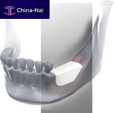 Allograft bone substitute for dental sugeryrigid
