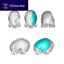 Custom-made cranial implant